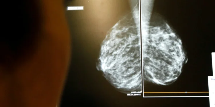 AI breast screening