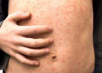 measles outbreak London schools
