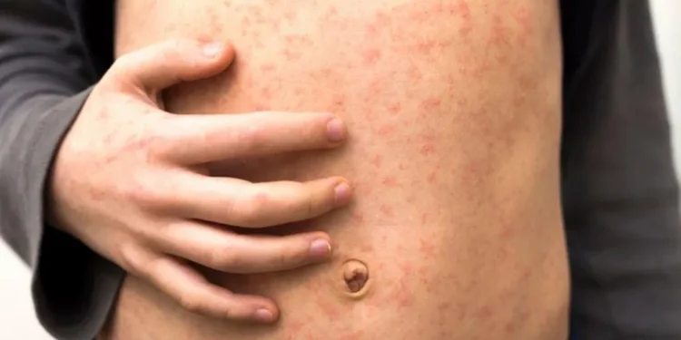 measles outbreak London schools