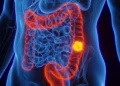 Cancer rises faster among younger adults, study finds