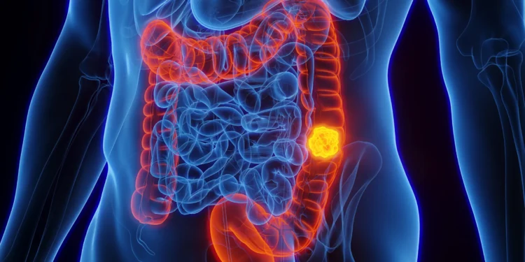 Cancer rises faster among younger adults, study finds